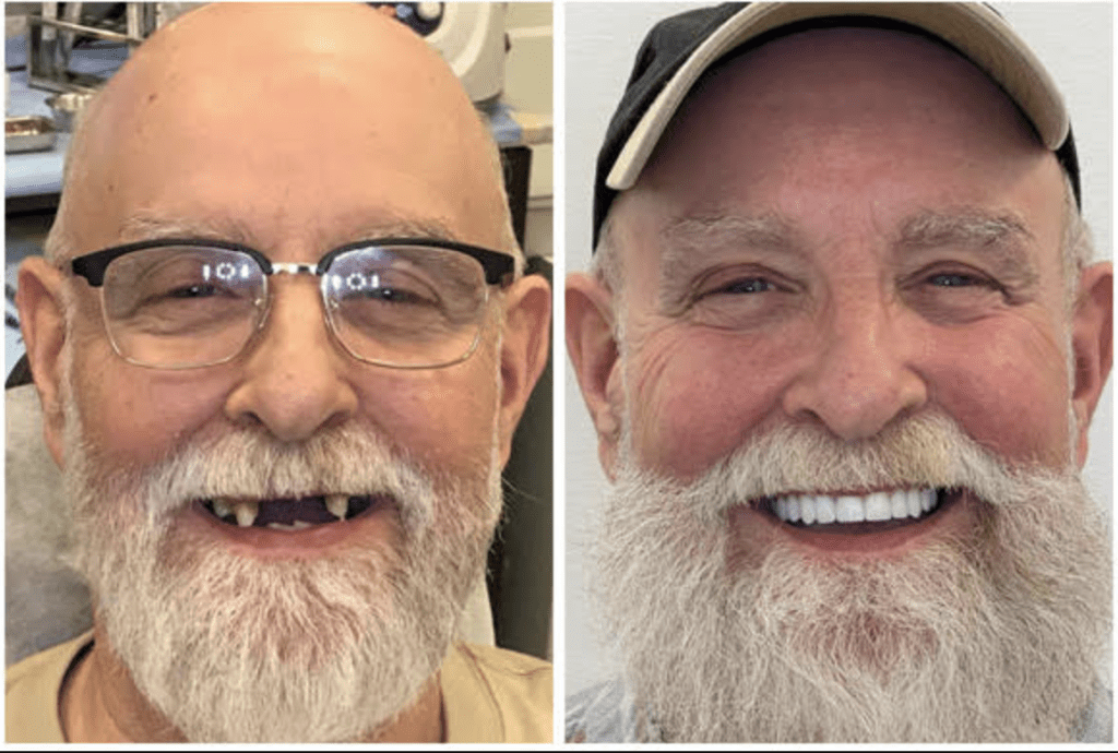 All On 4 Implants SD Denture Clinic