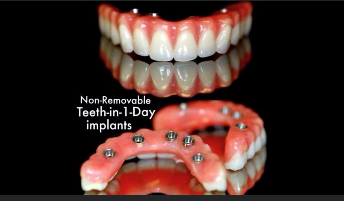 Removable Dentures on Implants SD Denture Clinic Overdentures on